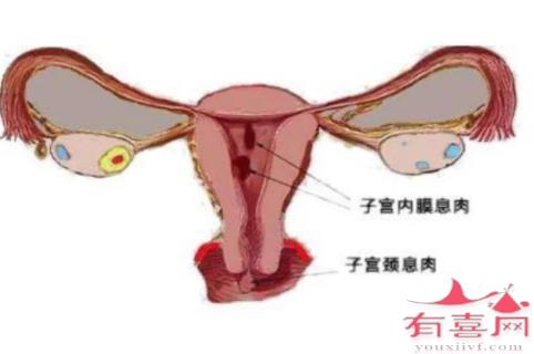 南宁代生中介高端群：子宫内膜息肉是否影响排卵？
